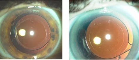 Private cataract surgery near Huddersfield & Halifax .